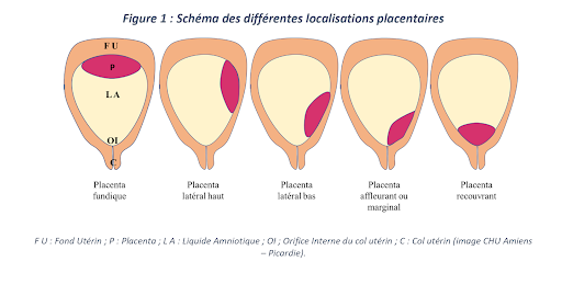 Schéma présentant les différentes localisations du placenta : fundique, latéral haut, latéral bas, affleurant ou recouvrant.